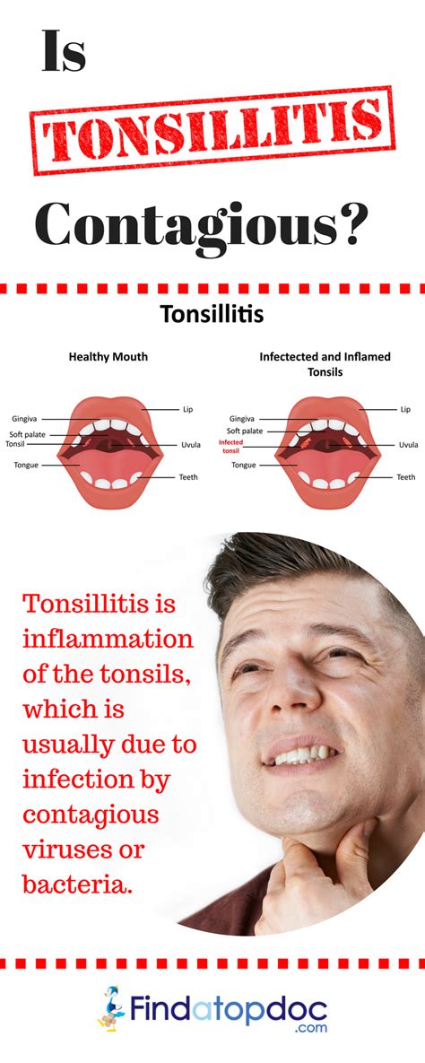 how contagious is tonsillitis