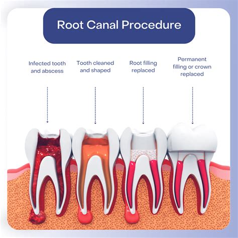 How Deep Is A Root Canal