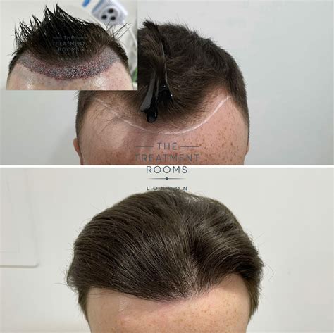  79 Ideas How Dense Can A Hair Transplant Be With Simple Style