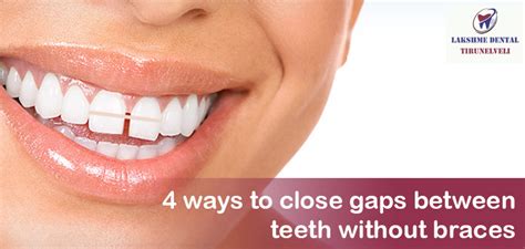 Closing Gap Composite Bonding at Frank Farley blog