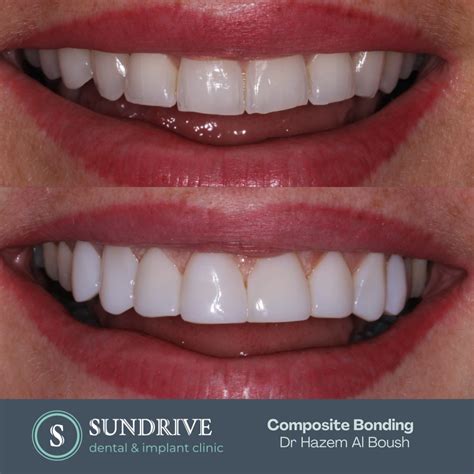 Composite Bonding Coatbridge Family Dental Care