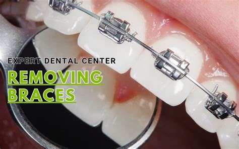 removing braces orthodontic YouTube