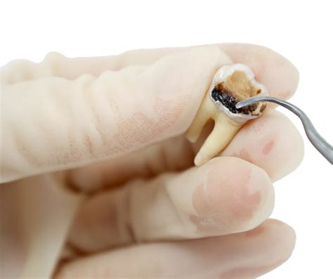 Dental Cavity Removal Stock Photo Download Image Now iStock