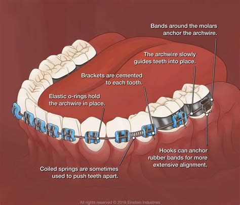 How Do Bands Work Braces