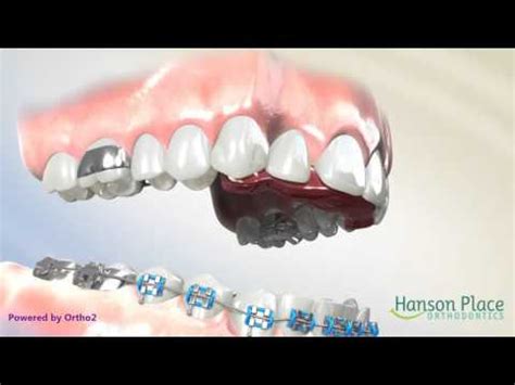 How Do Bite Plates Work