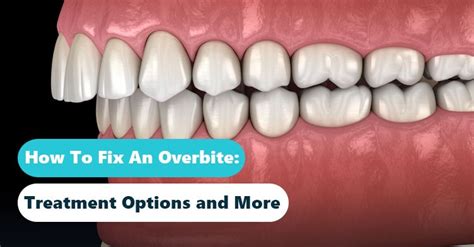 What is dental overbite? Dr Jamilian