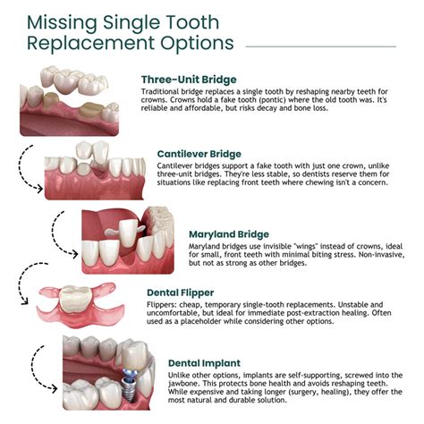 4 Ways to Replace a Missing Tooth University Dental San Diego