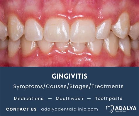 A DENTIST FRIEND TOLD ME HOW TO ELIMINATE TARTAR, GINGIVITIS AND WHITEN