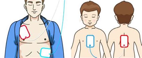 How Do External Defibrillator Work