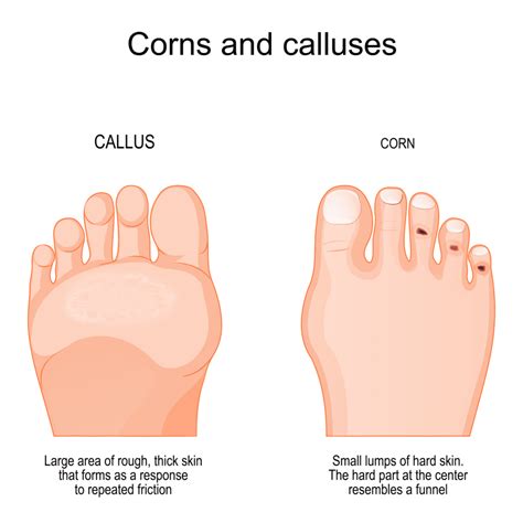 How Do Feet Corns Form