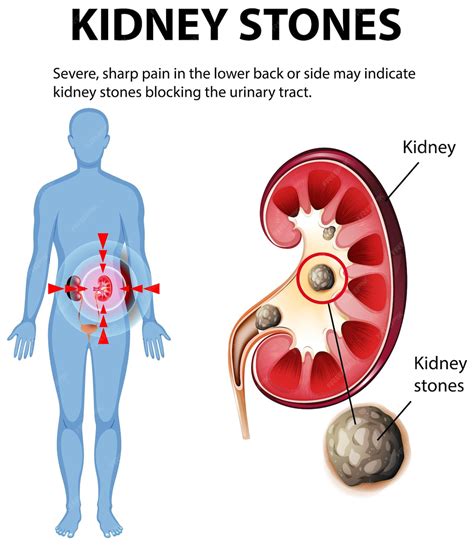 What Happens To Your Kidneys When You Have Kidney Stones