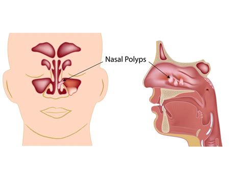 How Do Nasal Polyps Form