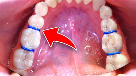 How Do Spacers Get Put In