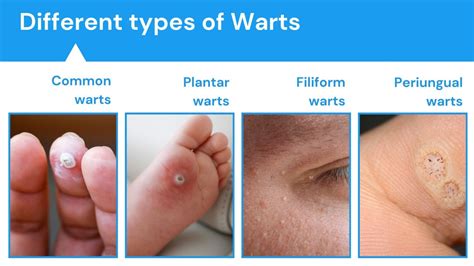 Understanding Warts: How Do Warts Form on the Skin