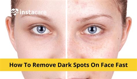 how do you get rid of red spots on your face fast