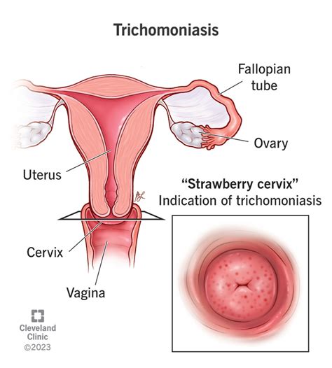 Understanding Trich: How Do You Get Trichomoniasis Infection?