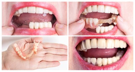 How Do You Remove A Partial Upper Denture