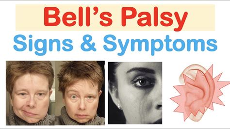 how do you spell bell's palsy