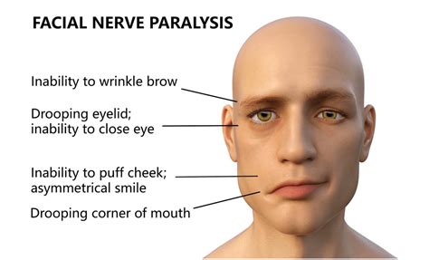 how do you treat bell palsy