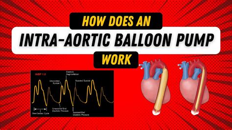 How Does A Balloon Pump Work
