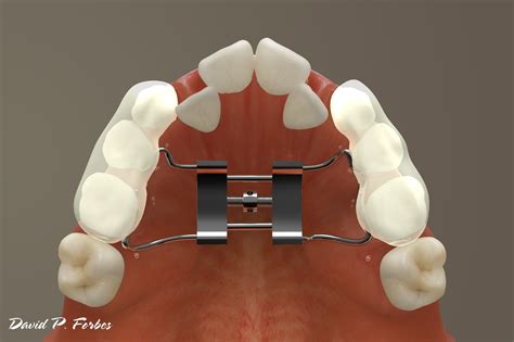 How Does A Band Expander Work
