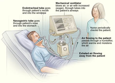 How Does A Breathing Ventilator Work
