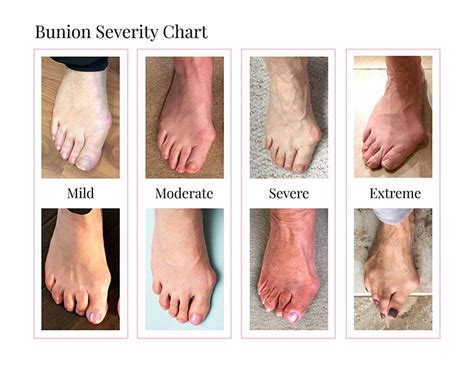 How Does A Bunion Form