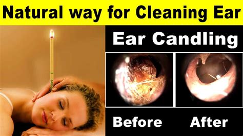 How Does A Candle Clean Your Ear