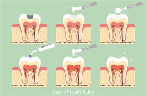 Safe Mercury Dental Filling Removal
