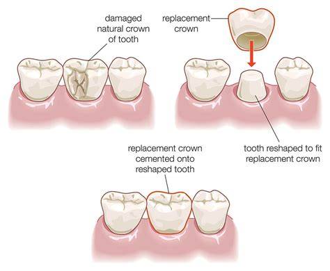Dr. Huszti demo Crown off? Cement a loose temporary crown step by