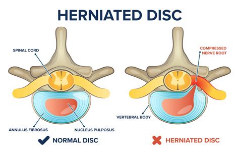 How Does A Disc Get Herniated