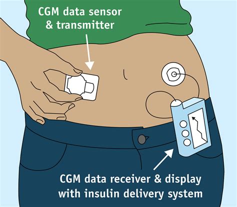 how does a glucose monitoring system work
