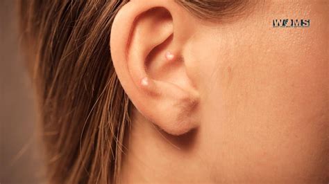 How Does A Pimple Form In Your Ear