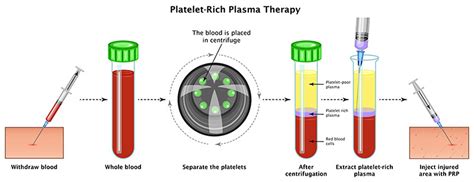 How Does A Plasma Chamber Work