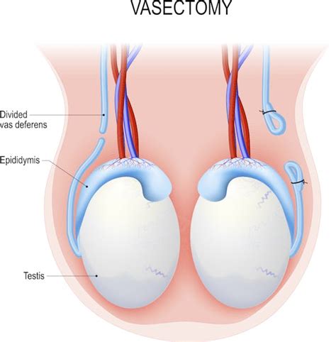 Understanding Vasectomy: How Does a Vasectomy Work and What to Expect