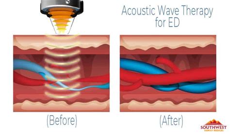 How Does Acoustic Wave Therapy For Ed Work