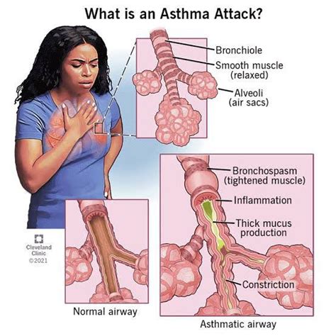 How Does An Asthma Attack Kill You