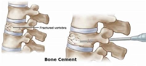 How Does Bone Cement Work
