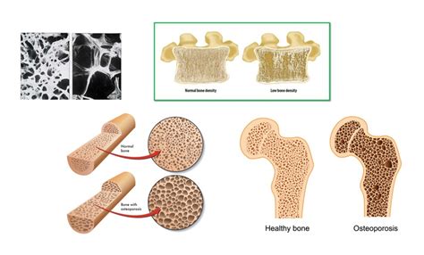 How Does Bone Density Work
