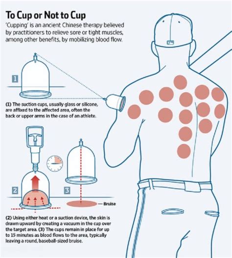 Cupping Therapy Helps Athletes Recover