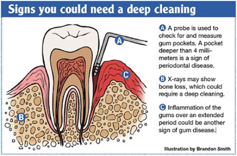 How Does Deep Cleaning Teeth Work