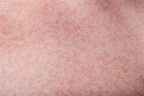 how does dengue rash look like