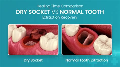 What is Dry Socket? Symptoms and how to fix it! OdontoVida