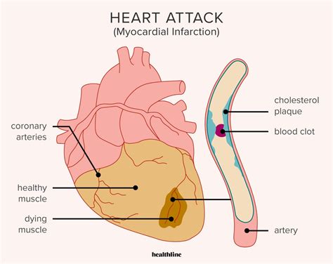How Does Diclofenac Cause Heart Attacks