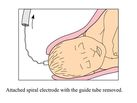 How Does Fetal Spiral Electrode Work