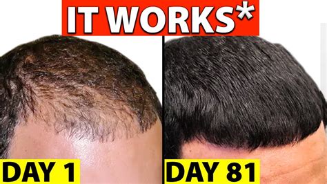 how does finasteride work for hair growth