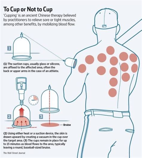 Fire Cupping Therapy Works