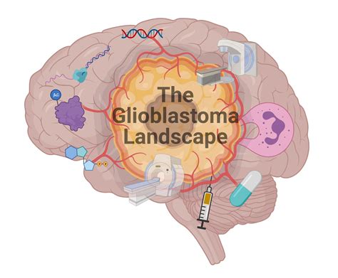 how does glioblastoma progress