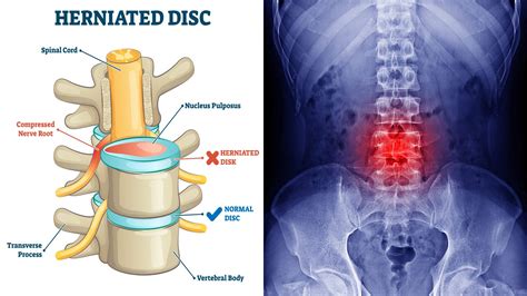 How Does Ice Help Herniated Disc