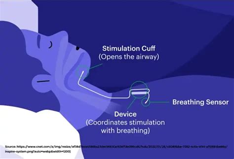 how does inspire work to treat sleep apnea
